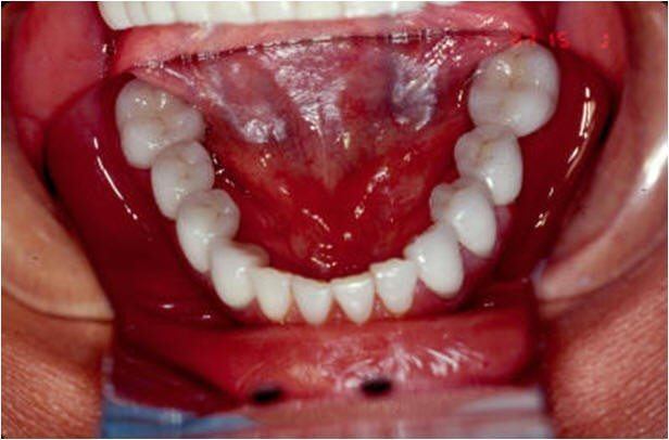 Completed Restorative Treatment of Lower Arch