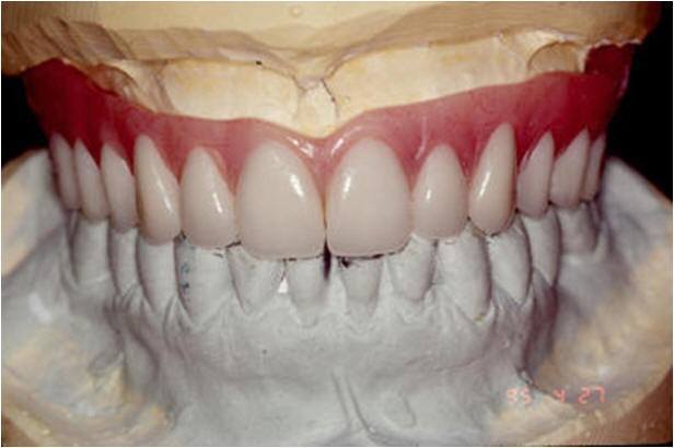 Planning for Aesthetics of the Maxillary Bridge