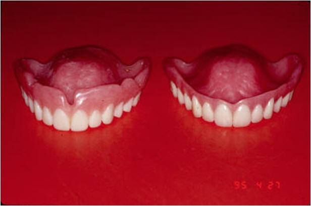 reatment Denture and Surgical Template for Implant Guide