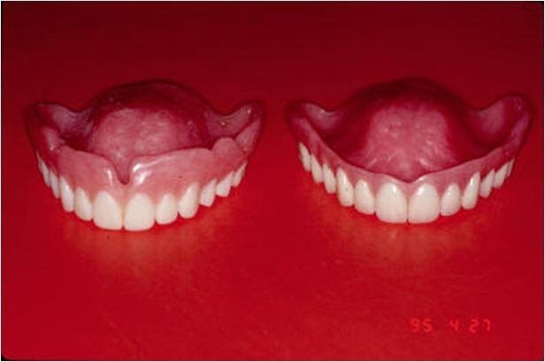 reatment Denture and Surgical Template for Implant Guide