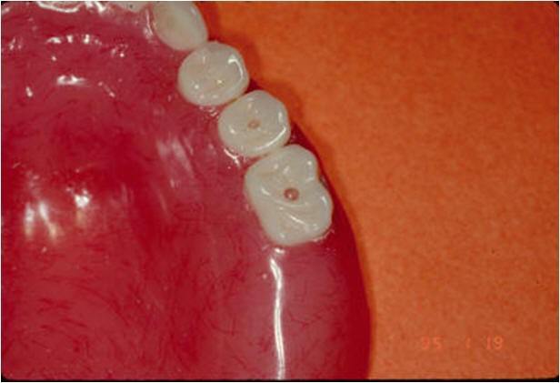 Holes in CT Scan Appliance for Radiopaque Composite