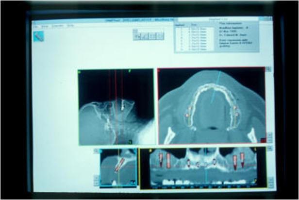 Simplant Program for Implant Planning and Placement