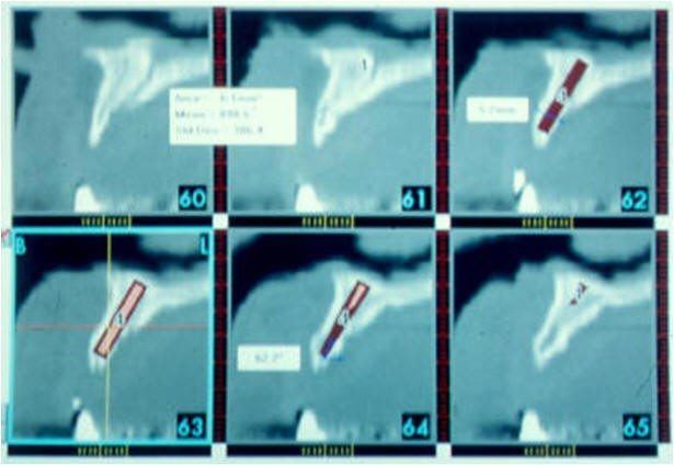 Simplant Program for Implant Planning and Placement