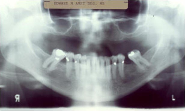 Initial Radiograph