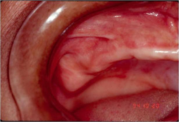 Original Appearance Intraoral