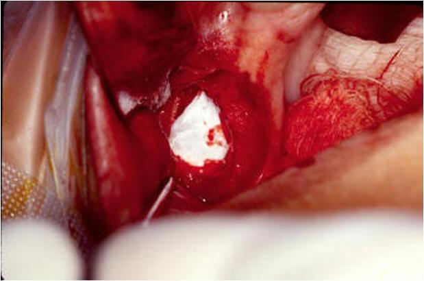 Lateral Entrance Into Maxillary Sinus With_Collatape