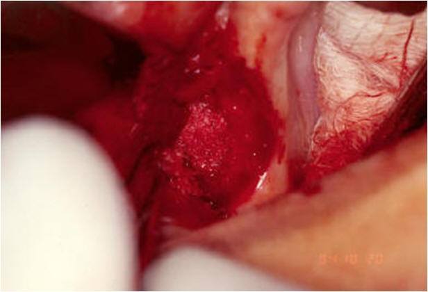 Grafting Into Sinus Cavity