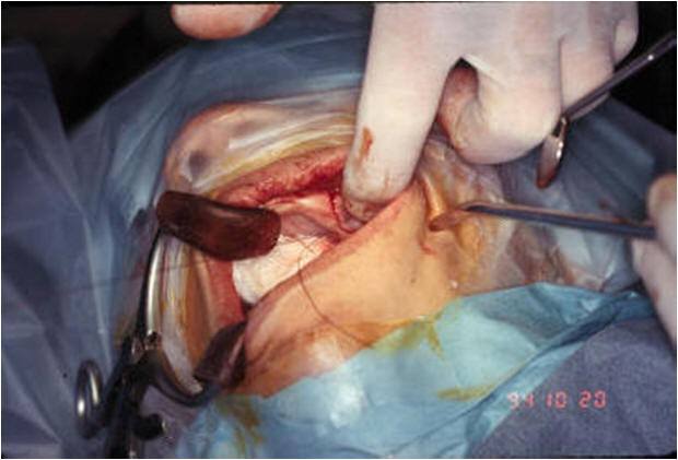 Suture Closure of Opening Into Sinus