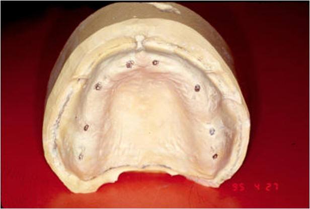 Pre-Op Planning for Implant Placement