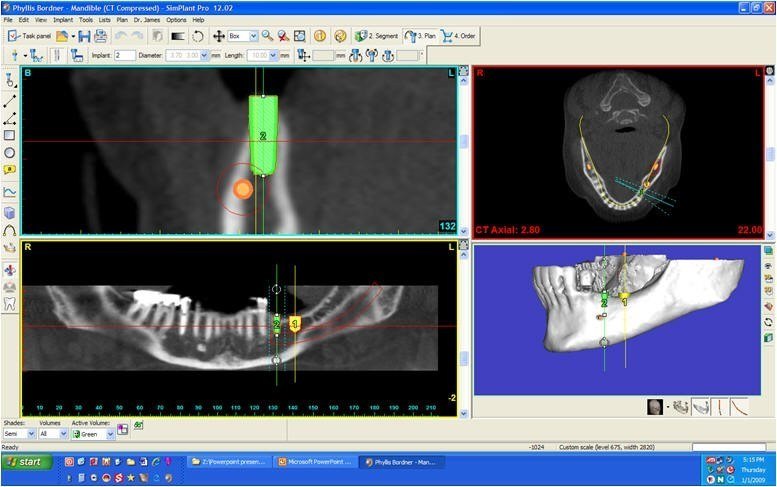 Simplant Study of Mandible