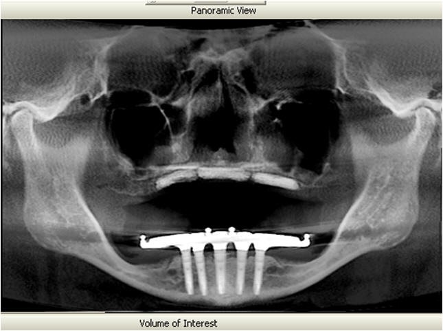 Five Year Post-Op Radiograph