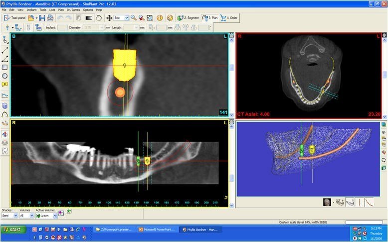 Simplant Study of Mandible