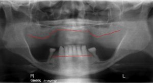 Initial Radiograph