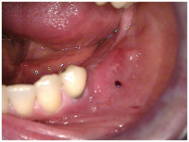 Primary Closure of Tissue Over Implants