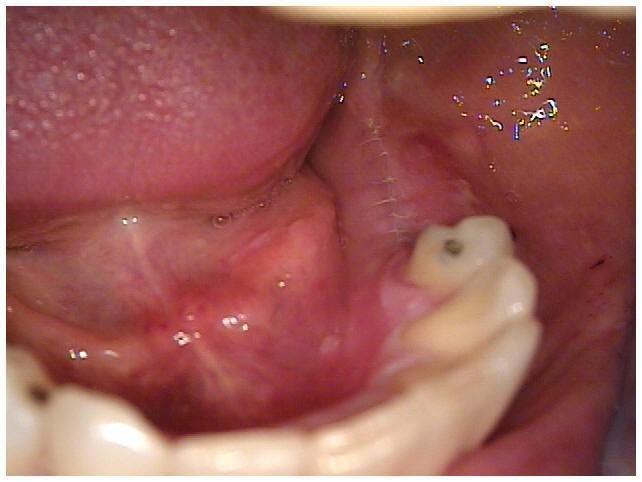 Primary Closure of Tissue Over Implants