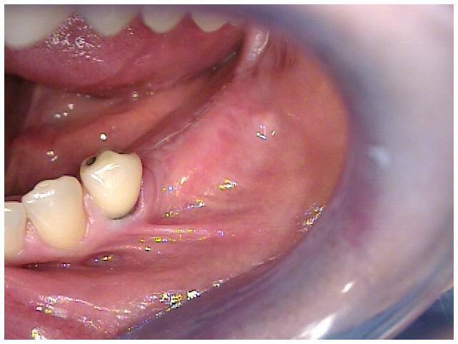 Primary Closure of Tissue Over Implants