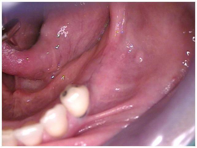 Primary Closure of Tissue Over Implants