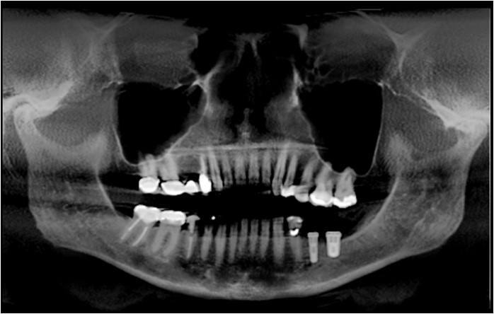 Primary Closure of Tissue Over Implants