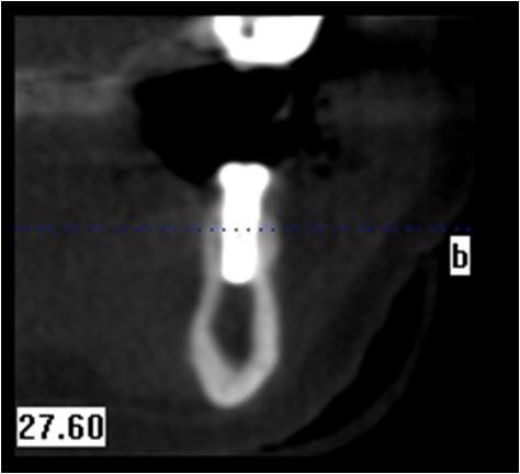 Six Month Post-Op Cross Sectional CBCT scan