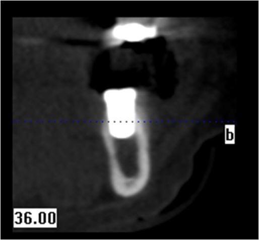 Six Month Post-Op Cross Sectional CBCT scan