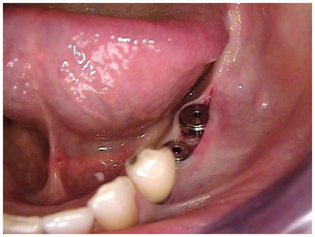 Six Month Post-Op with Second Stage Surgery