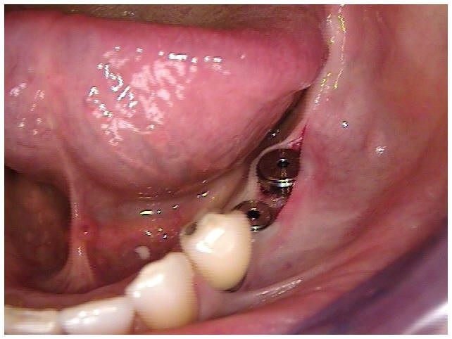 Six Month Post-Op with Second Stage Surgery