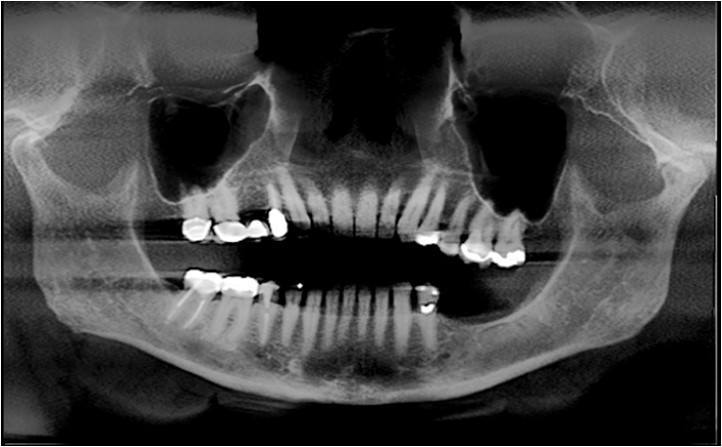  Pre-Op Panoramic Radiograph