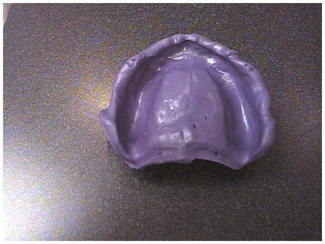  Maxillary Denture Reline