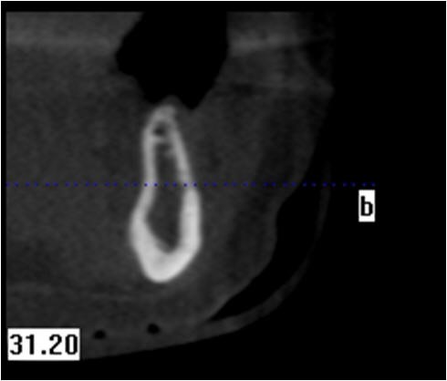 Pre-Op Initial Cross Sectional