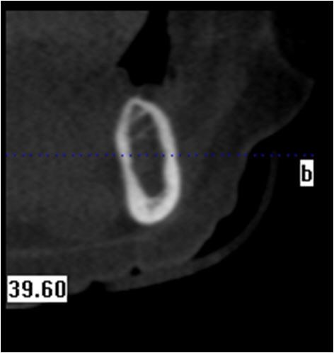 Pre-Op Initial Cross Sectional