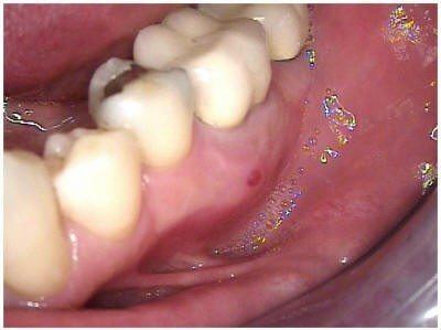 Chronic Abscess(1)