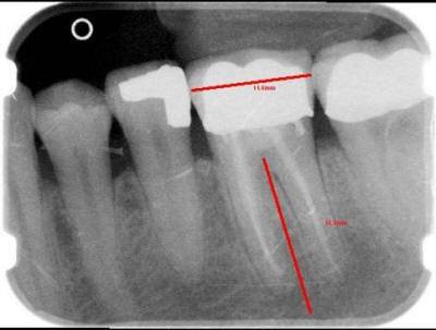 Chronic Abscess(2)