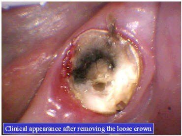 TOOTH BUILDUP (2)