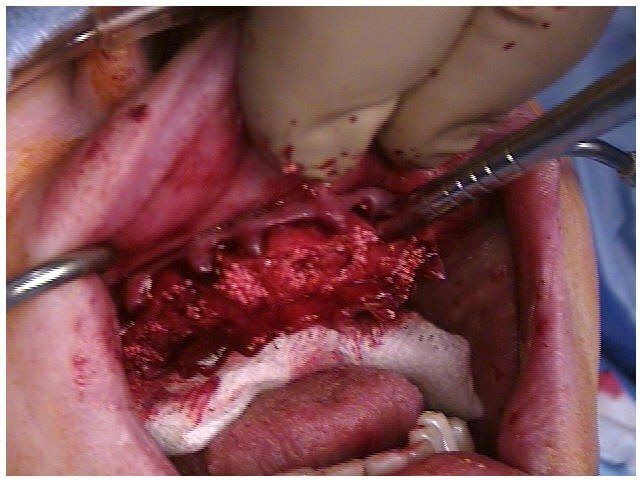 Alveoloplasty Compaction and HTR Grafting(1)