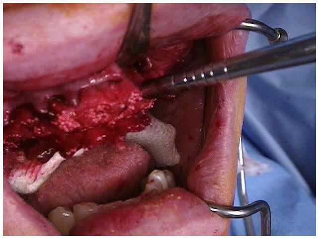 Alveoloplasty Compaction and HTR Grafting(2)