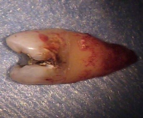 Extracted Tooth