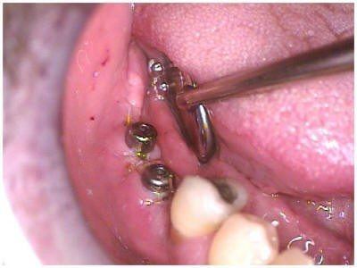 RAMUS GRAFT TO MANDIBLE(1)