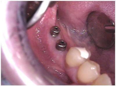 RAMUS GRAFT TO MANDIBLE(2)