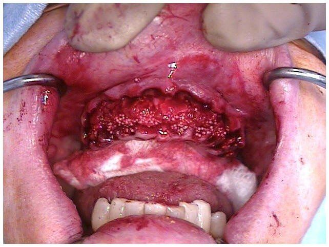 Alveoloplasty Compaction and HTR Grafting(1