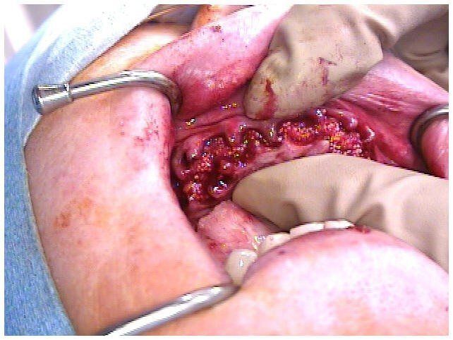 Alveoloplasty Compaction and HTR Grafting(2)