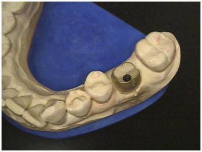 Custom Abutment on Master Cast (1)