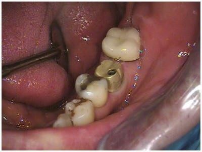 Custom Abutment on Master Cast (2)