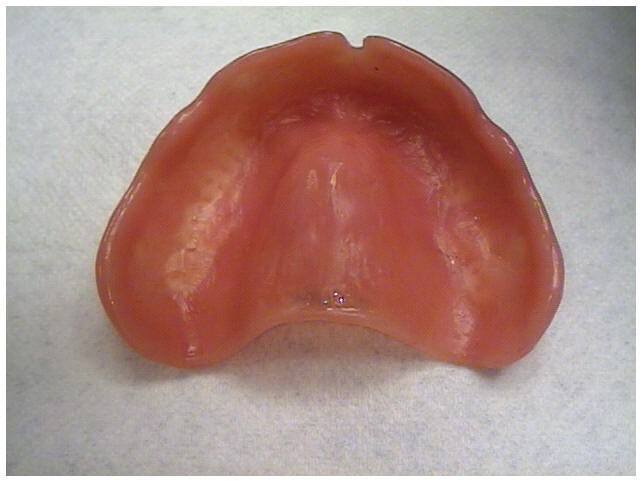 Intaglio Surface of Maxillary Denture