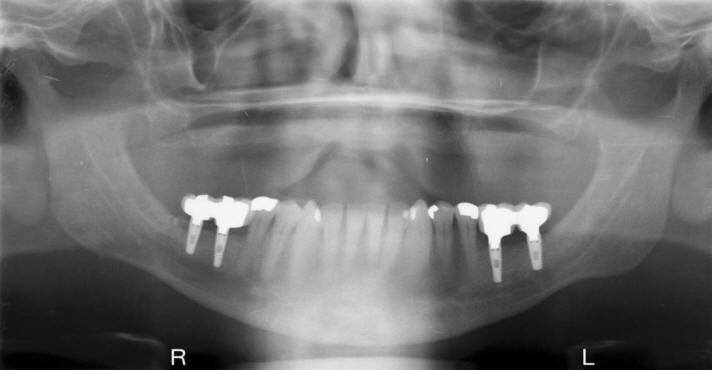 RAMUS GRAFT TO MANDIBLE