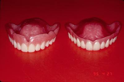 Treatment Denture & Surgical