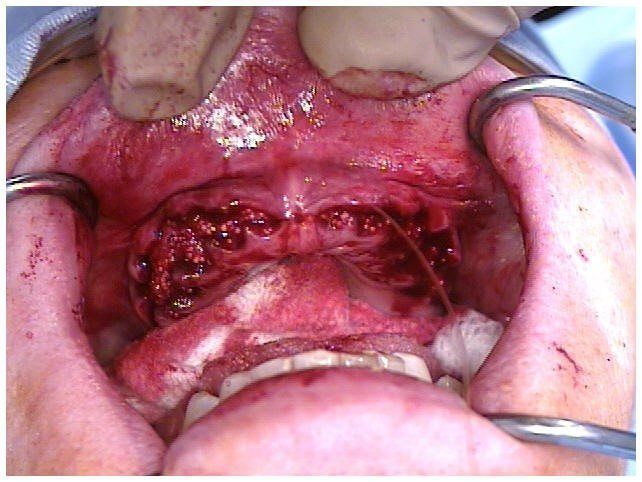 Alveoloplasty Compaction and HTR Grafting(1)