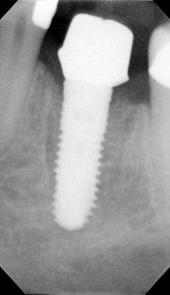 Radiograph of Custom Abutment