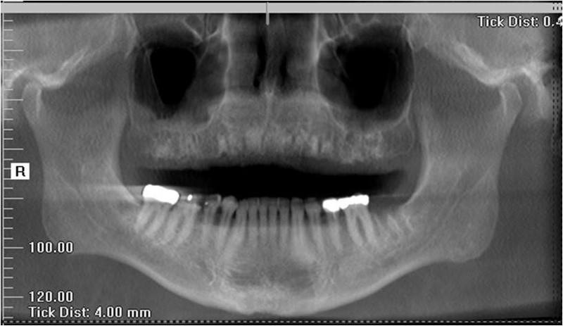 Post-Op Radiograph With HTR