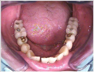 RAMUS GRAFT TO MANDIBLE