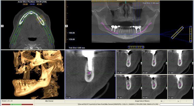 CBCT scan